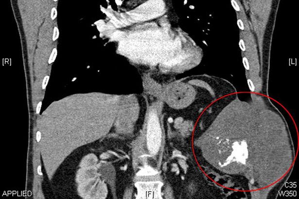 Doctors use cement in operation